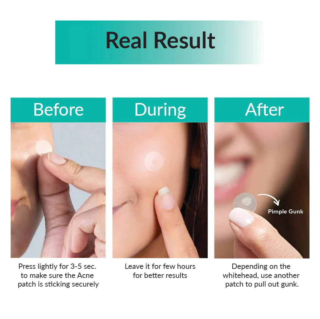 [SOMEBYMI] 30 Days Miracle Clear Spot Patch [18 pcs] - 